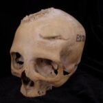 Ancient Egyptian skull may show attempts to treat cancer | Tech News