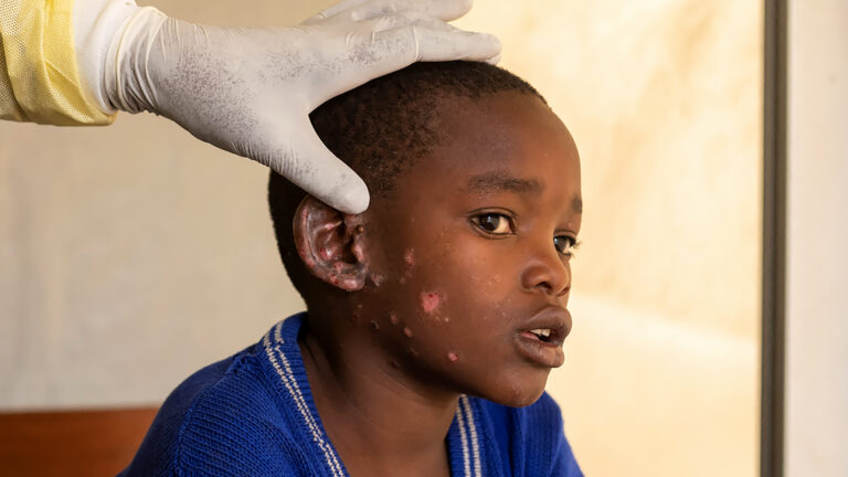 Deadlier Mpox threat makes troubling return to the US but experts warn Americans are in the dark about risks